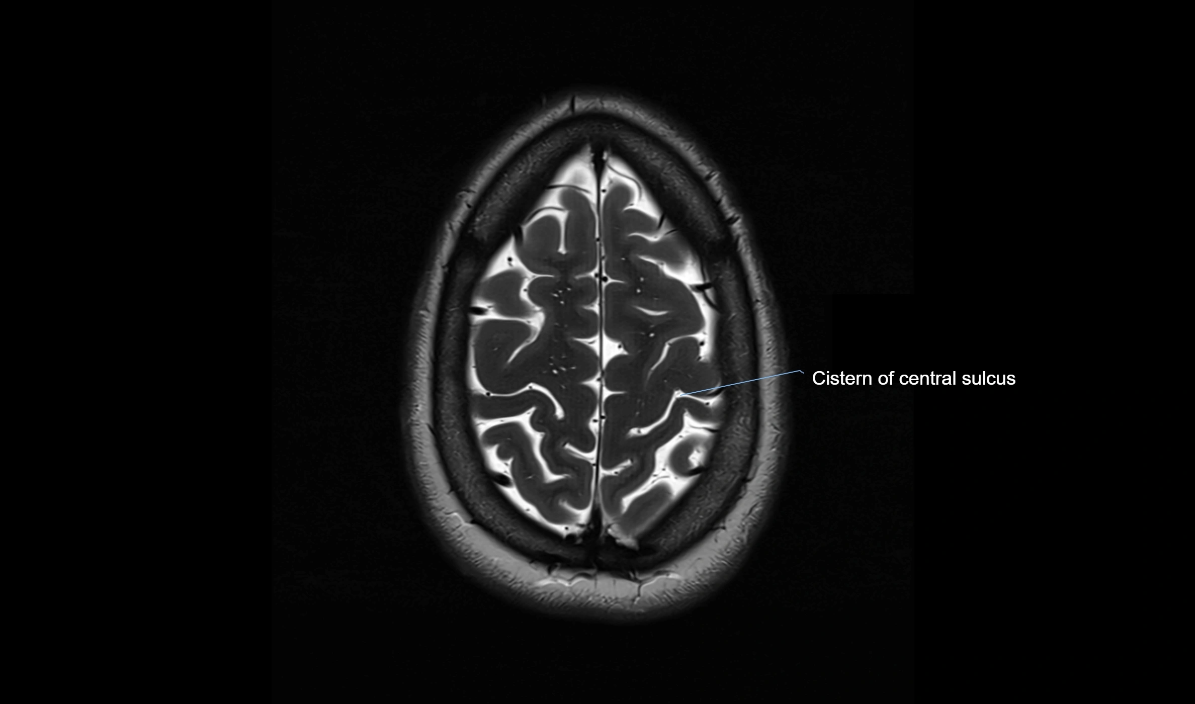 Brain cisterns  and ventricles  axial anatomy 3T MRI image-img-00001-00051.webp